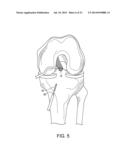 SYSTEM FOR ACL RECONSTRUCTION USING RETROGRADE CUTTER diagram and image