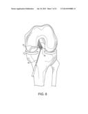 SYSTEM FOR ACL RECONSTRUCTION USING RETROGRADE CUTTER diagram and image