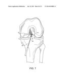 SYSTEM FOR ACL RECONSTRUCTION USING RETROGRADE CUTTER diagram and image