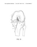 SYSTEM FOR ACL RECONSTRUCTION USING RETROGRADE CUTTER diagram and image