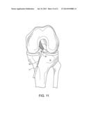 SYSTEM FOR ACL RECONSTRUCTION USING RETROGRADE CUTTER diagram and image