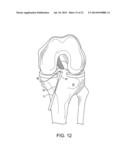 SYSTEM FOR ACL RECONSTRUCTION USING RETROGRADE CUTTER diagram and image