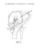 SYSTEM FOR ACL RECONSTRUCTION USING RETROGRADE CUTTER diagram and image