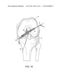 SYSTEM FOR ACL RECONSTRUCTION USING RETROGRADE CUTTER diagram and image