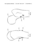 FIXATION SYSTEMS AND METHODS diagram and image