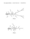 CONNECTION OF AN ENDOVASCULAR INTERVENTION DEVICE TO A MANIPULATION MEMBER diagram and image