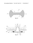 UMBILICAL HERNIA PROSTHESIS diagram and image