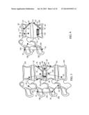 DEVICES AND METHODS FOR STABILIZING TISSUE AND IMPLANTS diagram and image