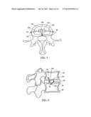 DEVICES AND METHODS FOR STABILIZING TISSUE AND IMPLANTS diagram and image