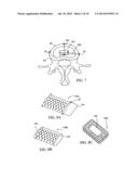 DEVICES AND METHODS FOR STABILIZING TISSUE AND IMPLANTS diagram and image