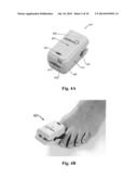 Device and Method of Treating Fungal Nail Infections diagram and image