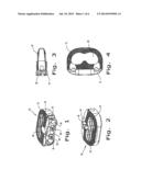 Intervertebral Fusion Implant diagram and image