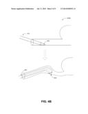 TRANS-URETHRAL SLING DELIVERY DEVICE diagram and image