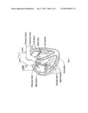 METHOD AND APPARATUS FOR EXTERNAL STABILIZATION OF THE HEART diagram and image