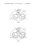 METHOD AND APPARATUS FOR EXTERNAL STABILIZATION OF THE HEART diagram and image