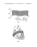 METHOD AND APPARATUS FOR EXTERNAL STABILIZATION OF THE HEART diagram and image
