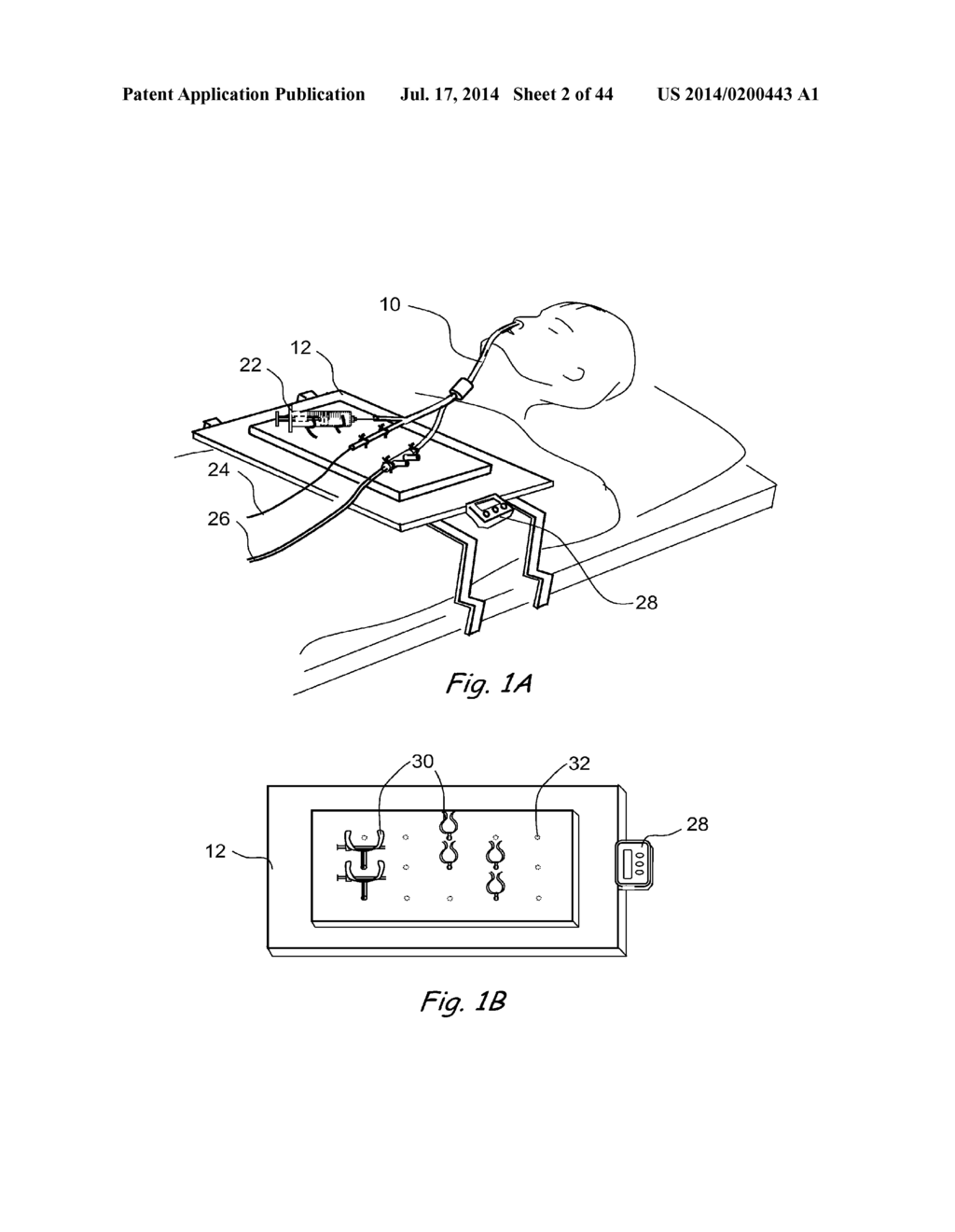 DEVICES, SYSTEMS AND METHODS FOR TREATING DISORDERS OF THE EAR, NOSE AND     THROAT - diagram, schematic, and image 03