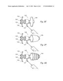 DEVICES, SYSTEMS AND METHODS FOR TREATING DISORDERS OF THE EAR, NOSE AND     THROAT diagram and image