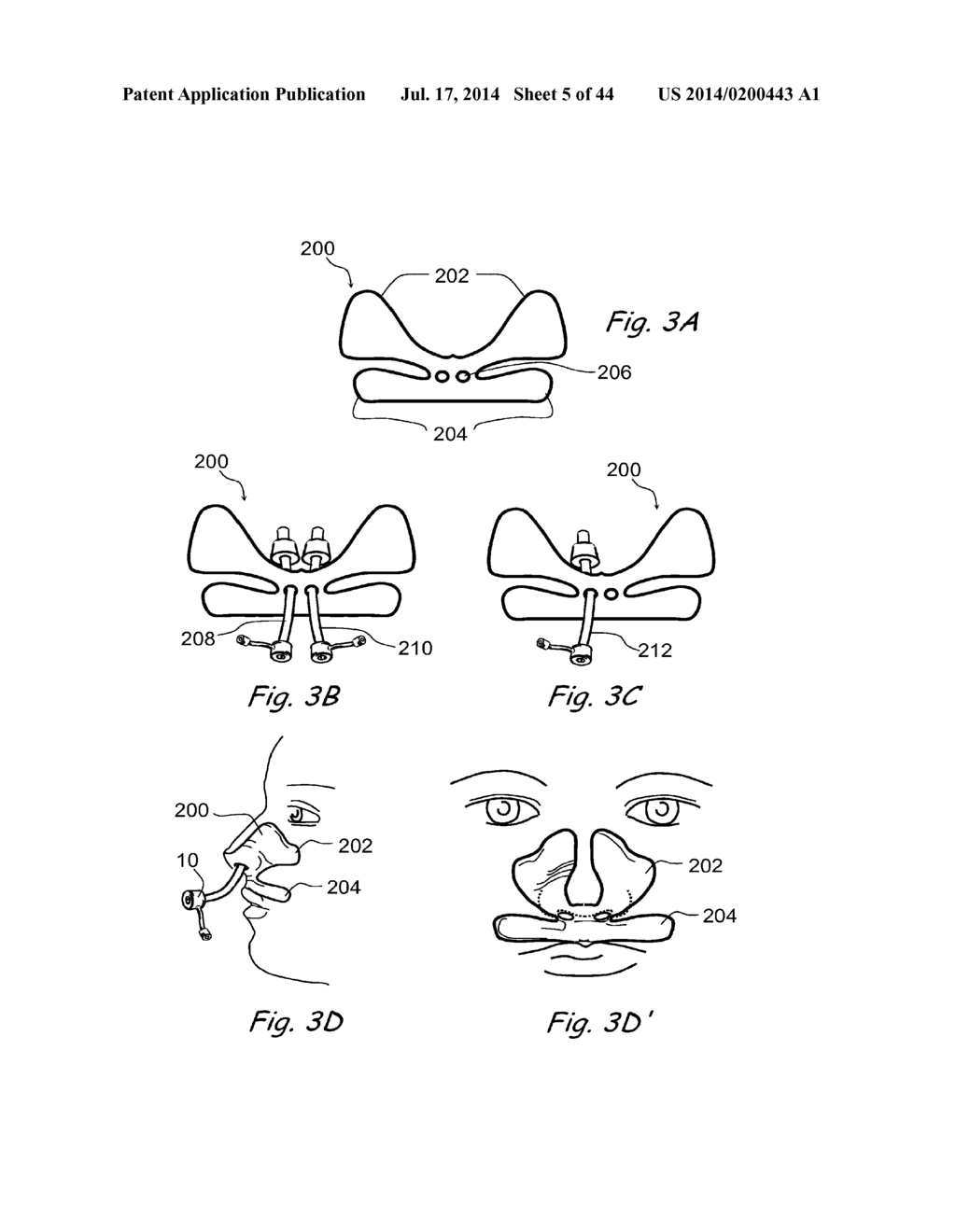 DEVICES, SYSTEMS AND METHODS FOR TREATING DISORDERS OF THE EAR, NOSE AND     THROAT - diagram, schematic, and image 06