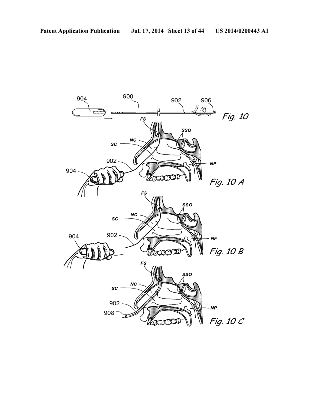 DEVICES, SYSTEMS AND METHODS FOR TREATING DISORDERS OF THE EAR, NOSE AND     THROAT - diagram, schematic, and image 14