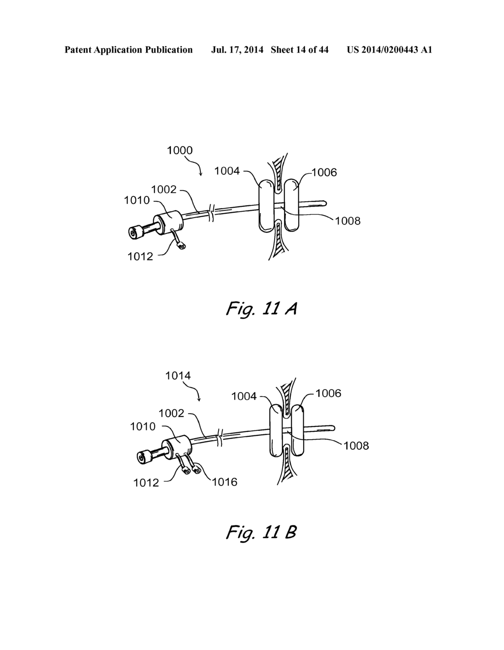 DEVICES, SYSTEMS AND METHODS FOR TREATING DISORDERS OF THE EAR, NOSE AND     THROAT - diagram, schematic, and image 15