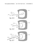 DEVICES, SYSTEMS AND METHODS FOR TREATING DISORDERS OF THE EAR, NOSE AND     THROAT diagram and image