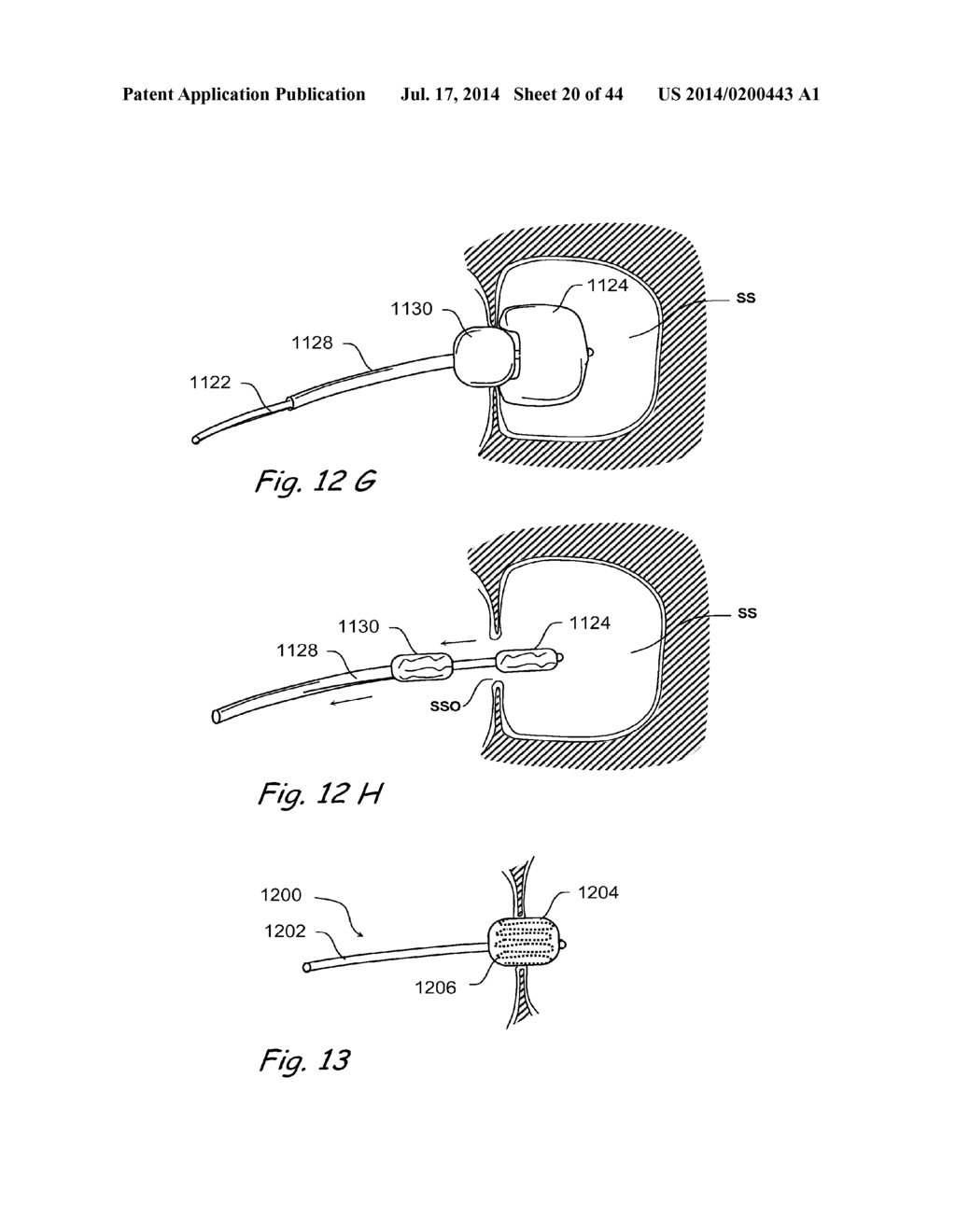 DEVICES, SYSTEMS AND METHODS FOR TREATING DISORDERS OF THE EAR, NOSE AND     THROAT - diagram, schematic, and image 21