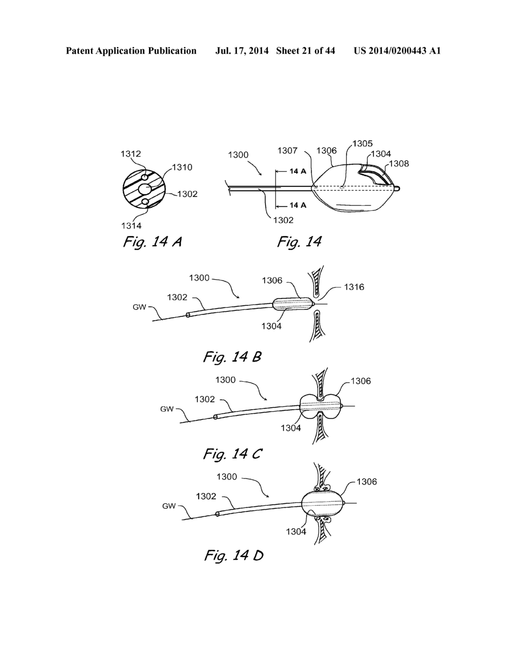 DEVICES, SYSTEMS AND METHODS FOR TREATING DISORDERS OF THE EAR, NOSE AND     THROAT - diagram, schematic, and image 22