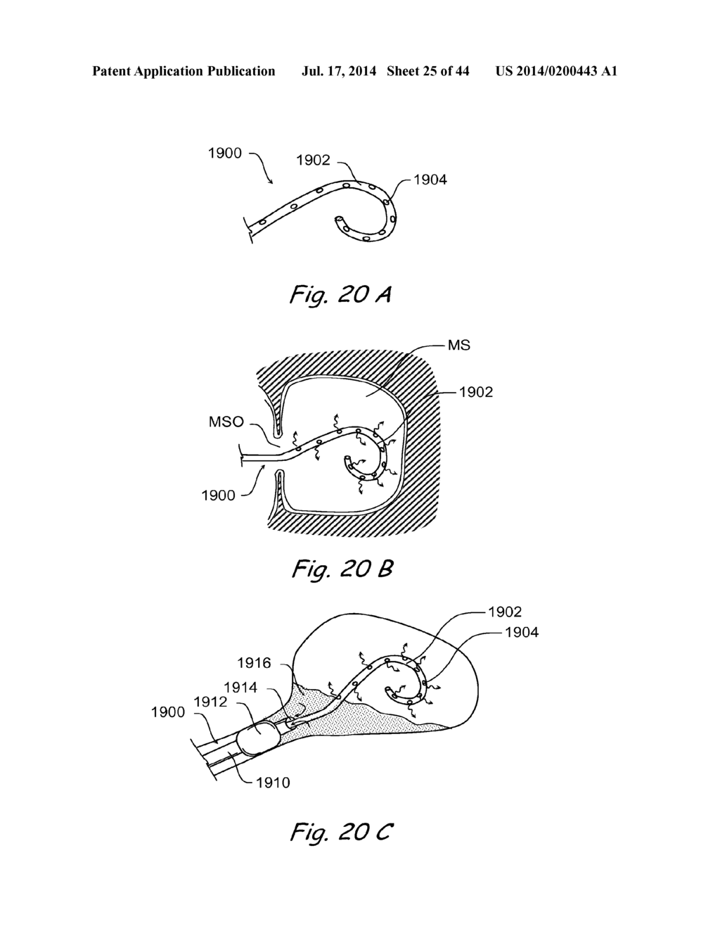 DEVICES, SYSTEMS AND METHODS FOR TREATING DISORDERS OF THE EAR, NOSE AND     THROAT - diagram, schematic, and image 26