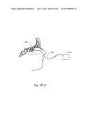 DEVICES, SYSTEMS AND METHODS FOR TREATING DISORDERS OF THE EAR, NOSE AND     THROAT diagram and image