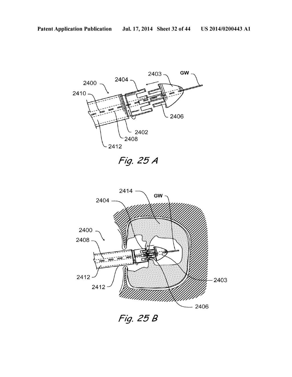 DEVICES, SYSTEMS AND METHODS FOR TREATING DISORDERS OF THE EAR, NOSE AND     THROAT - diagram, schematic, and image 33