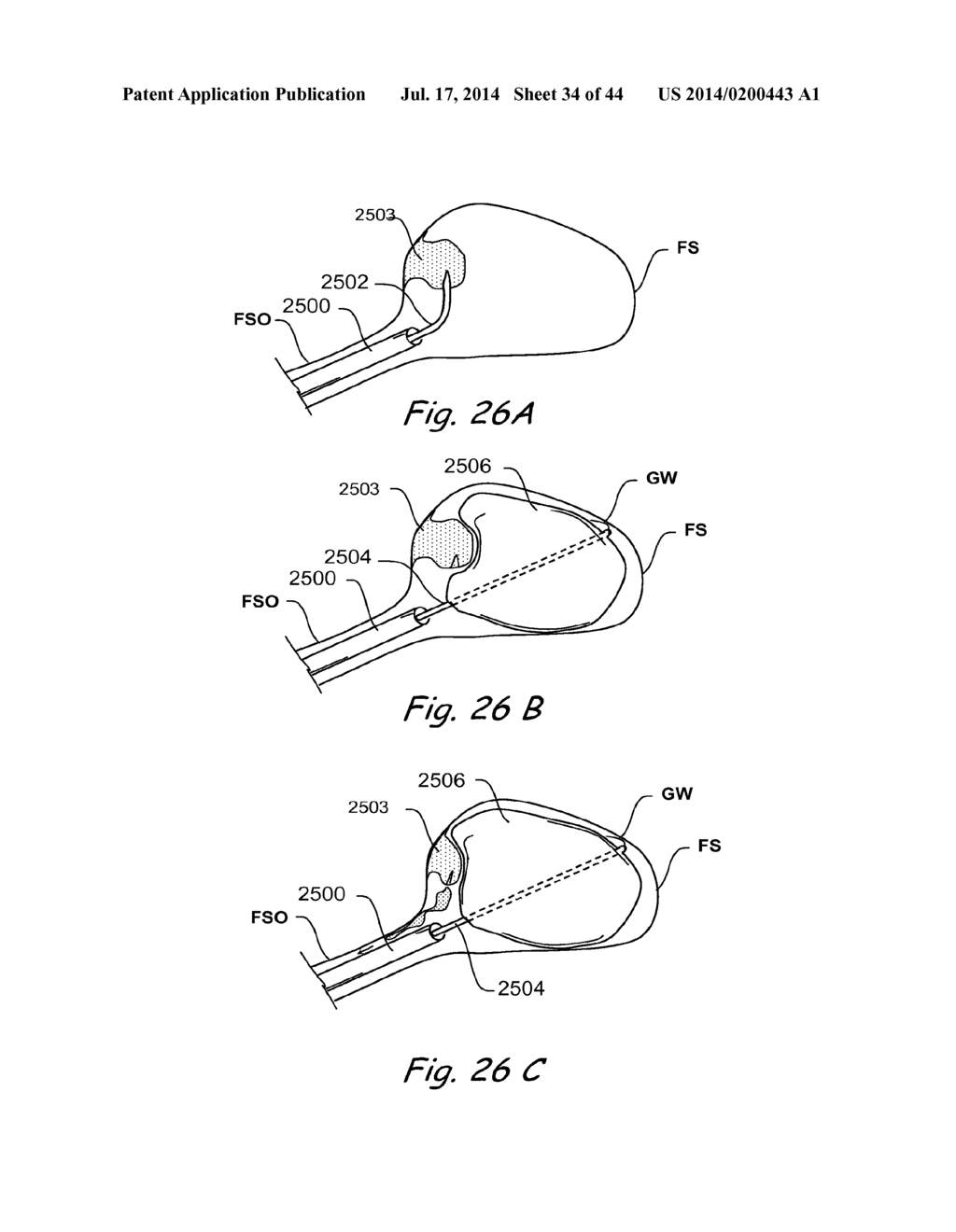 DEVICES, SYSTEMS AND METHODS FOR TREATING DISORDERS OF THE EAR, NOSE AND     THROAT - diagram, schematic, and image 35