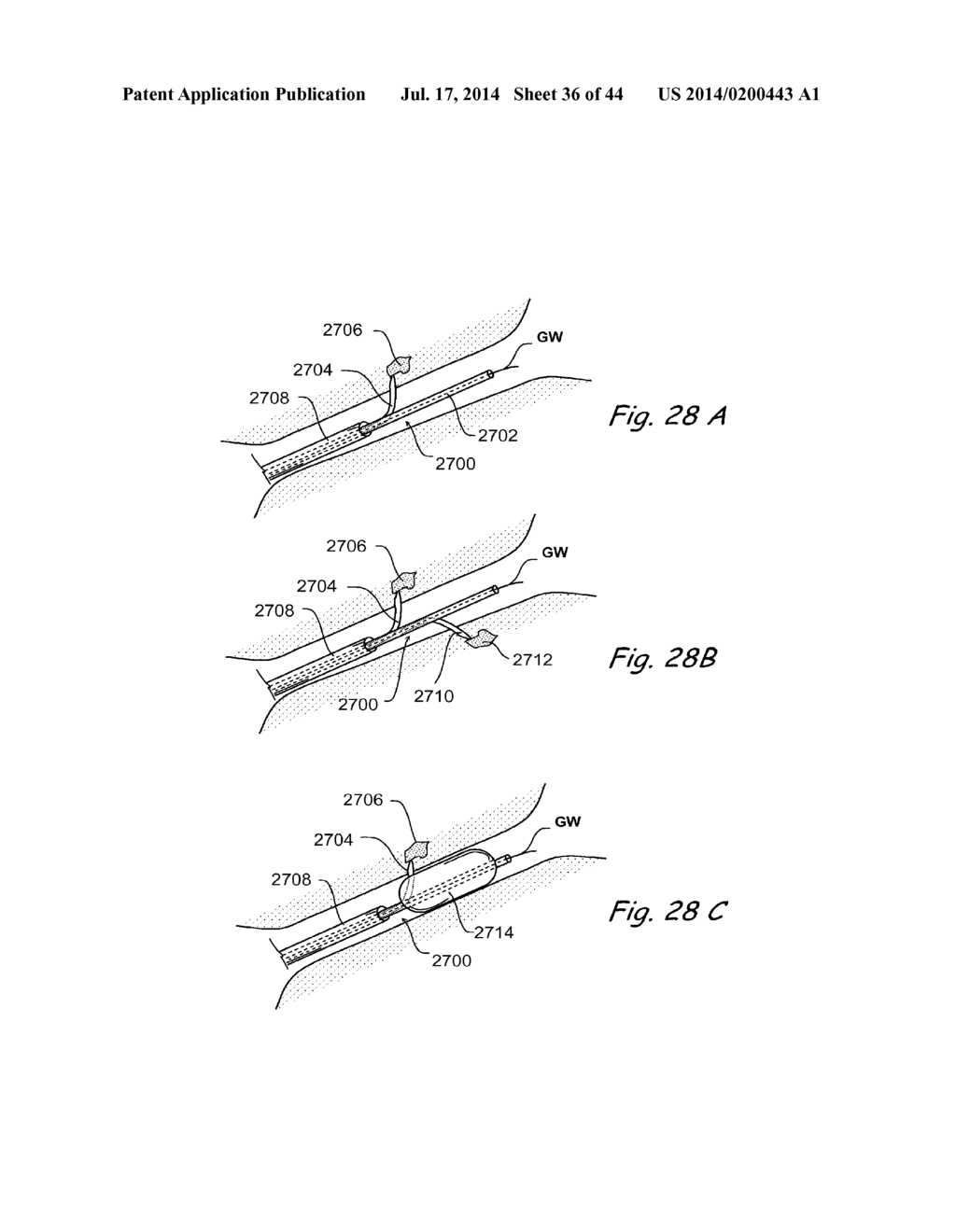 DEVICES, SYSTEMS AND METHODS FOR TREATING DISORDERS OF THE EAR, NOSE AND     THROAT - diagram, schematic, and image 37