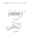 DEVICES, SYSTEMS AND METHODS FOR TREATING DISORDERS OF THE EAR, NOSE AND     THROAT diagram and image