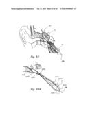 DEVICES, SYSTEMS AND METHODS FOR TREATING DISORDERS OF THE EAR, NOSE AND     THROAT diagram and image