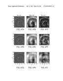 METHODS AND SYSTEMS FOR DETERMINING SPATIOTEMPORAL VARIABILITY FOR MAPPING     CARDIAC FIBRILLATION diagram and image