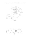 DEVICES AND SYSTEMS CONFIGURED TO FIT AROUND A TISSUE OR ORGAN AND METHODS     OF USING THE SAME diagram and image