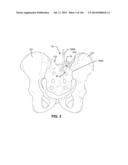 SYSTEMS AND METHODS FOR FUSING A SACROILIAC JOINT AND ANCHORING AN     ORTHOPEDIC APPLIANCE diagram and image
