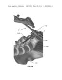 SYSTEMS AND METHODS FOR FUSING A SACROILIAC JOINT AND ANCHORING AN     ORTHOPEDIC APPLIANCE diagram and image