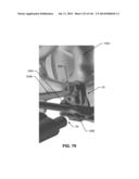 SYSTEMS AND METHODS FOR FUSING A SACROILIAC JOINT AND ANCHORING AN     ORTHOPEDIC APPLIANCE diagram and image