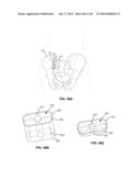 SYSTEMS AND METHODS FOR FUSING A SACROILIAC JOINT AND ANCHORING AN     ORTHOPEDIC APPLIANCE diagram and image