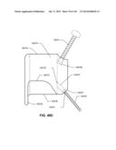 SYSTEMS AND METHODS FOR FUSING A SACROILIAC JOINT AND ANCHORING AN     ORTHOPEDIC APPLIANCE diagram and image