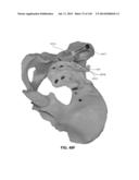 SYSTEMS AND METHODS FOR FUSING A SACROILIAC JOINT AND ANCHORING AN     ORTHOPEDIC APPLIANCE diagram and image