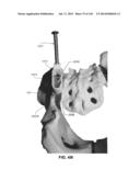 SYSTEMS AND METHODS FOR FUSING A SACROILIAC JOINT AND ANCHORING AN     ORTHOPEDIC APPLIANCE diagram and image