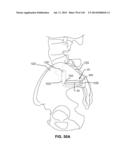 SYSTEMS AND METHODS FOR FUSING A SACROILIAC JOINT AND ANCHORING AN     ORTHOPEDIC APPLIANCE diagram and image