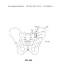 SYSTEMS AND METHODS FOR FUSING A SACROILIAC JOINT AND ANCHORING AN     ORTHOPEDIC APPLIANCE diagram and image