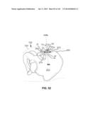 SYSTEMS AND METHODS FOR FUSING A SACROILIAC JOINT AND ANCHORING AN     ORTHOPEDIC APPLIANCE diagram and image