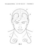 MRI-Safe Implantable Lead diagram and image