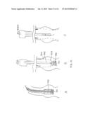 Systems, Methods and Devices for Retrograde Pericardial Release of a     Prosthetic Heart Valve diagram and image