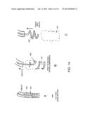 Systems, Methods and Devices for Retrograde Pericardial Release of a     Prosthetic Heart Valve diagram and image